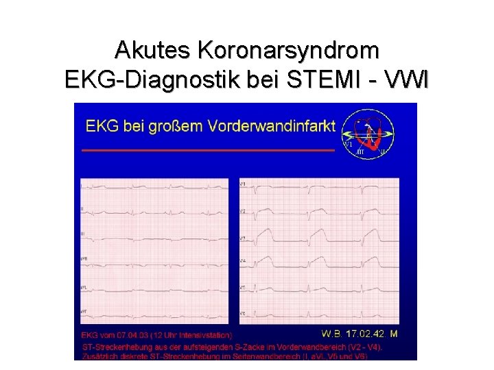 Akutes Koronarsyndrom EKG-Diagnostik bei STEMI - VWI 