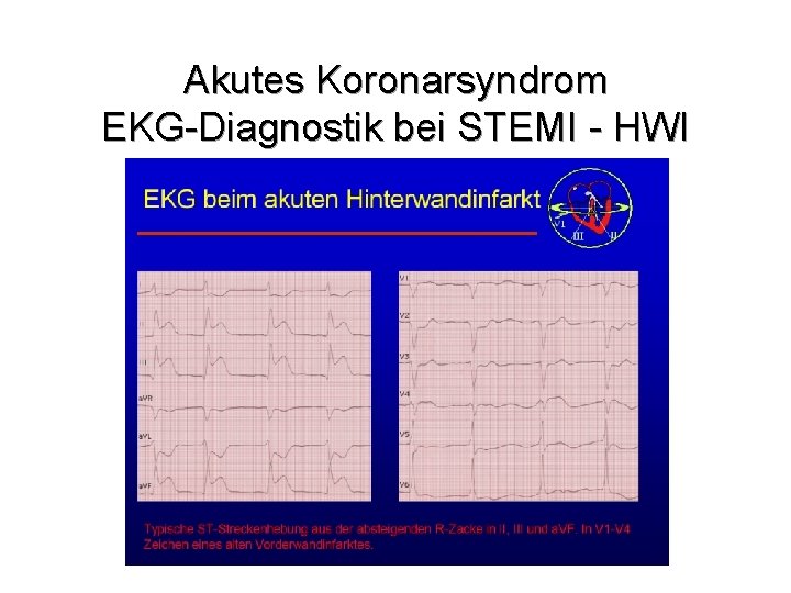 Akutes Koronarsyndrom EKG-Diagnostik bei STEMI - HWI 