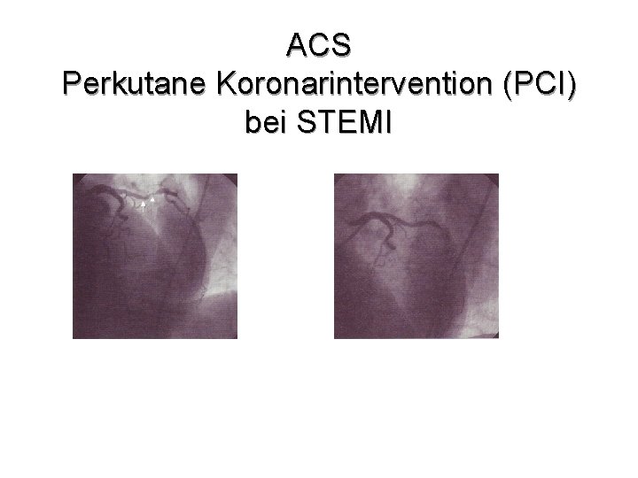 ACS Perkutane Koronarintervention (PCI) bei STEMI Vor Stent Nach Stent 