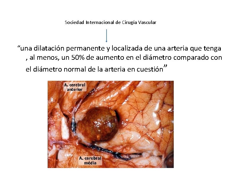 Sociedad Internacional de Cirugía Vascular “una dilatación permanente y localizada de una arteria que