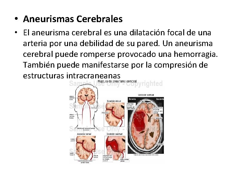  • Aneurismas Cerebrales • El aneurisma cerebral es una dilatación focal de una