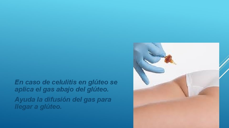 En caso de celulitis en glúteo se aplica el gas abajo del glúteo. Ayuda