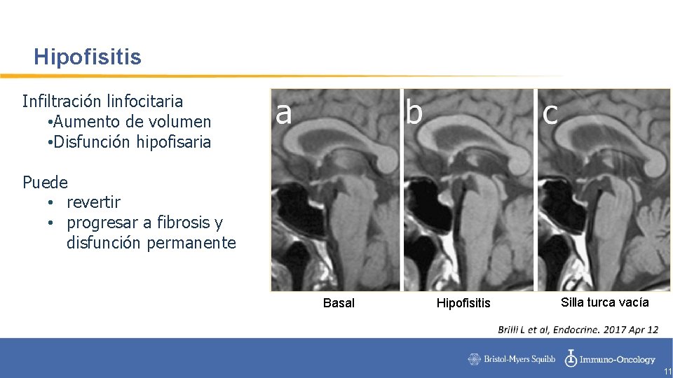 Hipofisitis Infiltración linfocitaria • Aumento de volumen • Disfunción hipofisaria Puede • revertir •