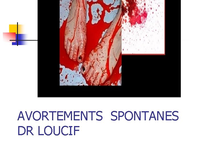 AVORTEMENTS SPONTANES DR LOUCIF 