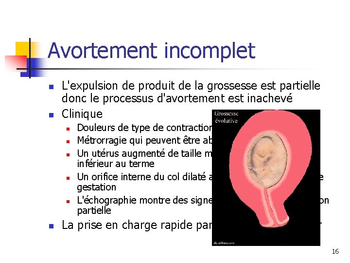 Avortement incomplet n n L'expulsion de produit de la grossesse est partielle donc le