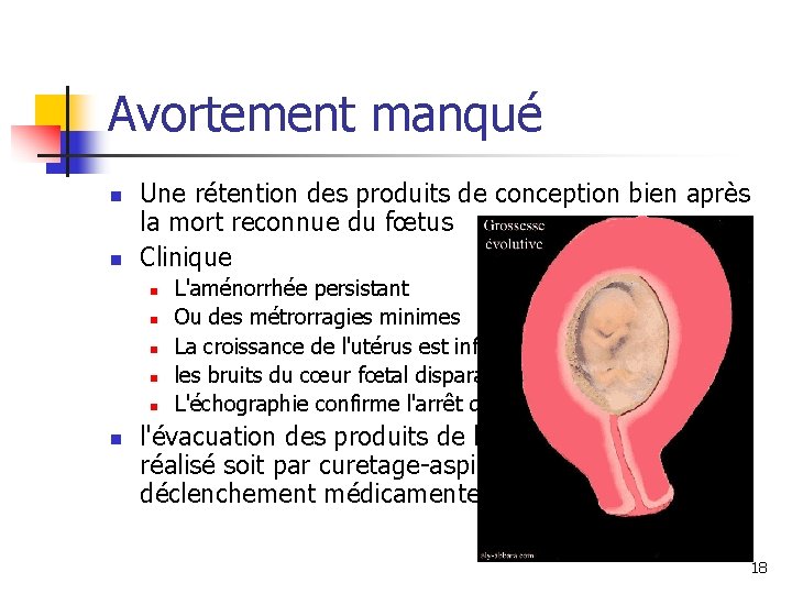 Avortement manqué n n Une rétention des produits de conception bien après la mort