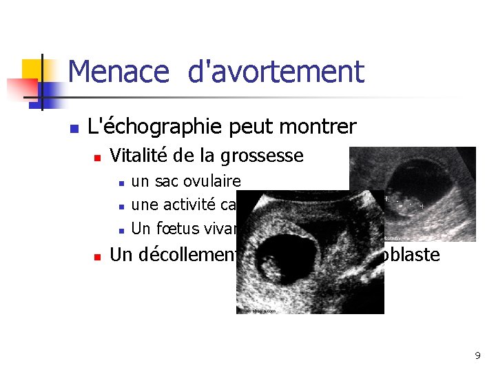 Menace d'avortement n L'échographie peut montrer n Vitalité de la grossesse n n un