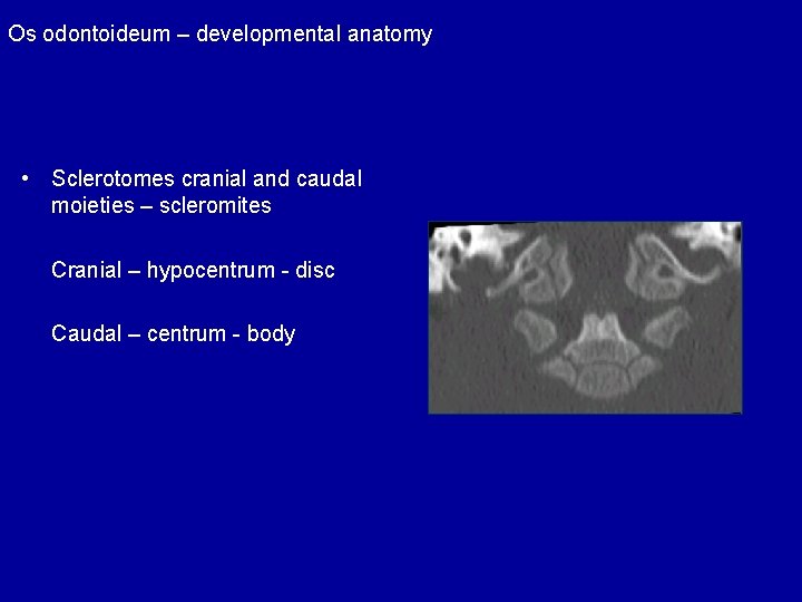 Os odontoideum – developmental anatomy • Sclerotomes cranial and caudal moieties – scleromites Cranial