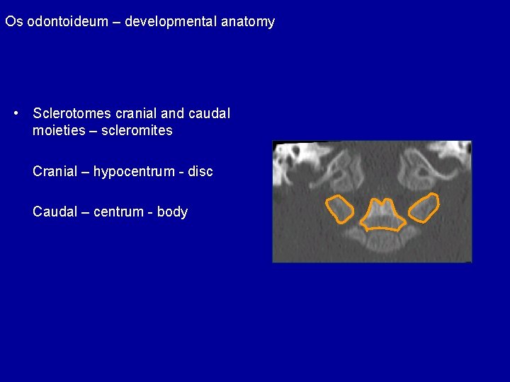 Os odontoideum – developmental anatomy • Sclerotomes cranial and caudal moieties – scleromites Cranial