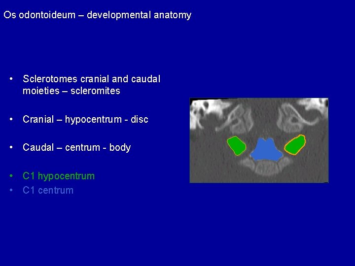 Os odontoideum – developmental anatomy • Sclerotomes cranial and caudal moieties – scleromites •