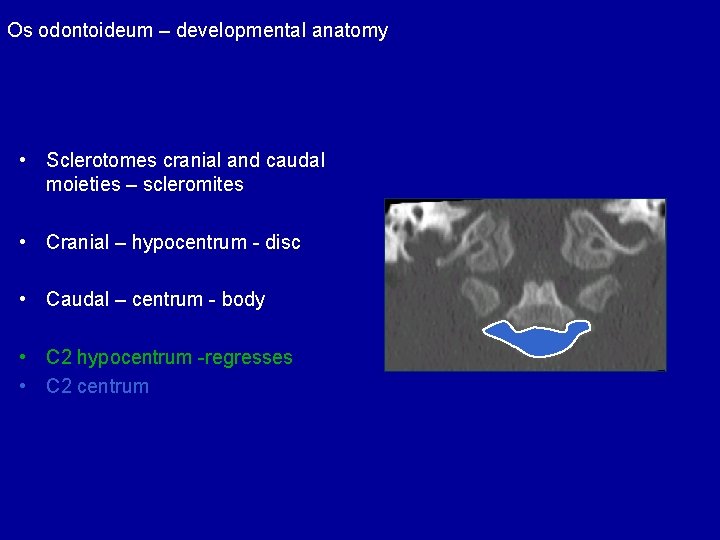 Os odontoideum – developmental anatomy • Sclerotomes cranial and caudal moieties – scleromites •