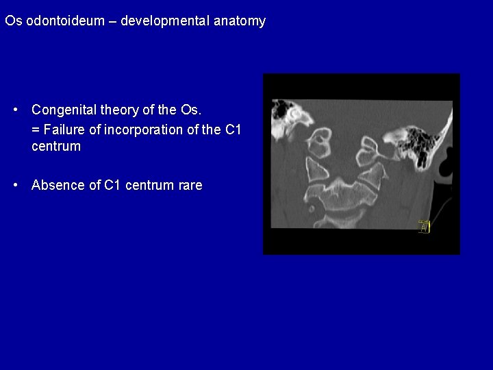 Os odontoideum – developmental anatomy • Congenital theory of the Os. = Failure of