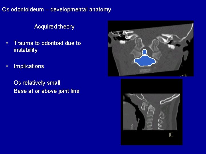 Os odontoideum – developmental anatomy Acquired theory • Trauma to odontoid due to instability