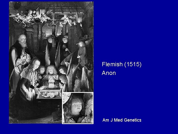 Flemish (1515) Anon Am J Med Genetics 