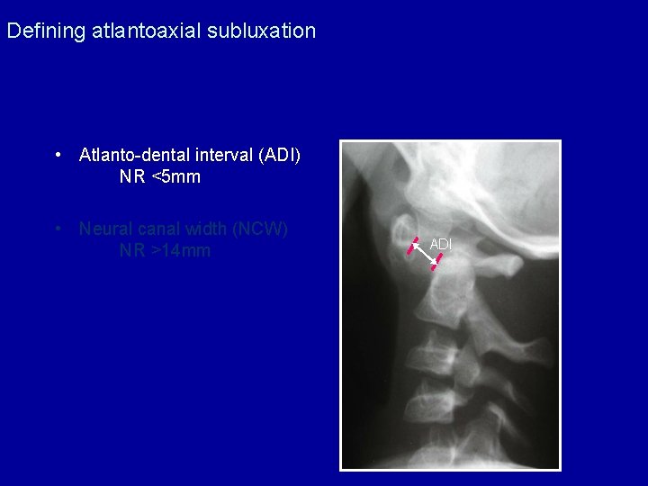Defining atlantoaxial subluxation • Atlanto-dental interval (ADI) NR <5 mm • Neural canal width