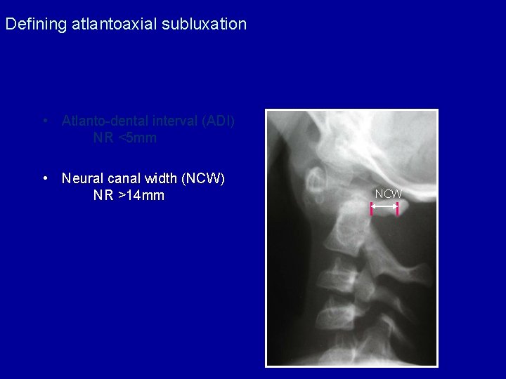 Defining atlantoaxial subluxation • Atlanto-dental interval (ADI) NR <5 mm • Neural canal width