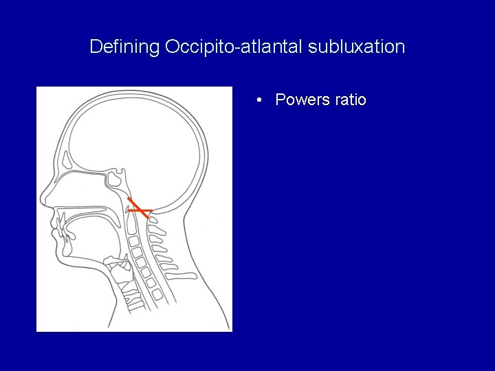 Defining Occipito-atlantal subluxation • Powers ratio 