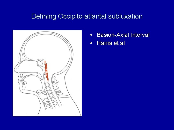 Defining Occipito-atlantal subluxation • Basion-Axial Interval • Harris et al 