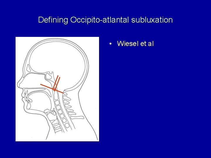 Defining Occipito-atlantal subluxation • Wiesel et al 