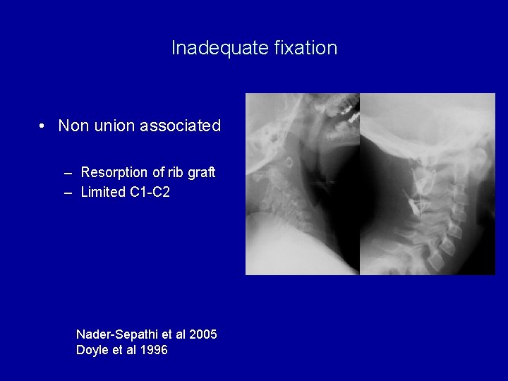 Inadequate fixation • Non union associated – Resorption of rib graft – Limited C
