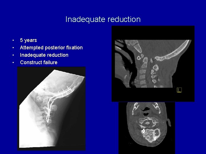 Inadequate reduction • • 5 years Attempted posterior fixation Inadequate reduction Construct failure 