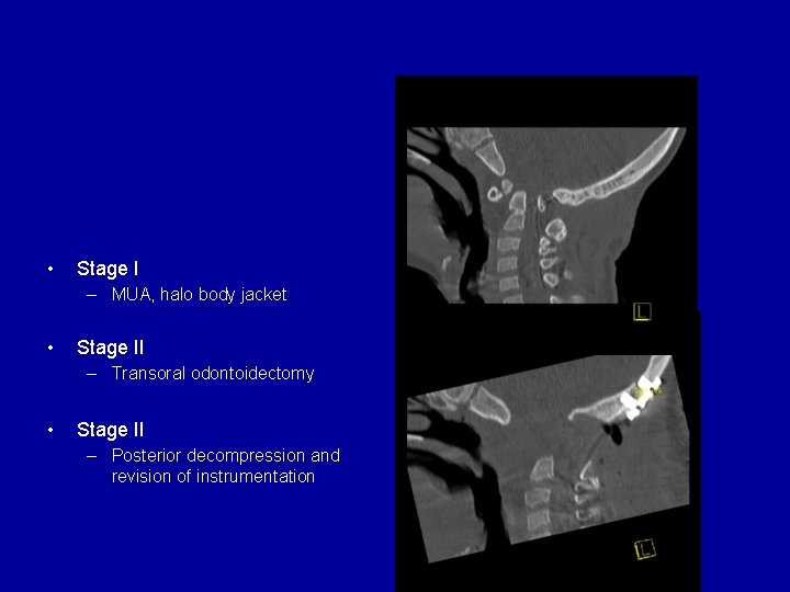 Case 1: Downs syndrome • Stage I – MUA, halo body jacket • Stage