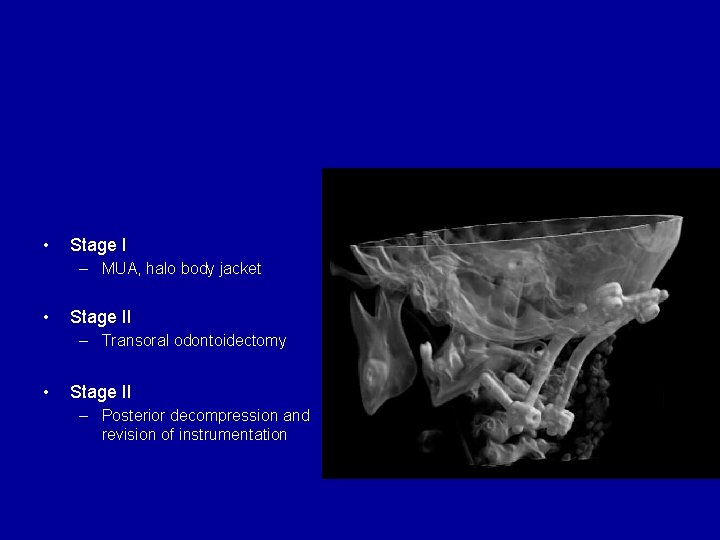 Case 1: Downs syndrome • Stage I – MUA, halo body jacket • Stage