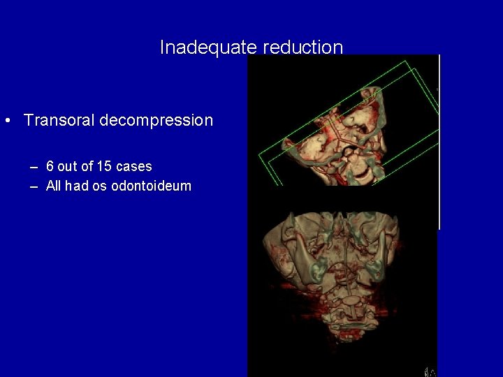 Inadequate reduction • Transoral decompression – 6 out of 15 cases – All had