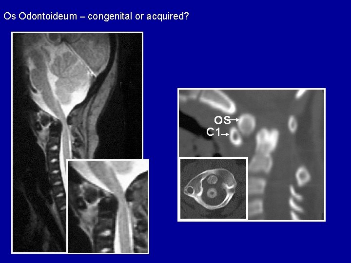 Os Odontoideum – congenital or acquired? OS C 1 