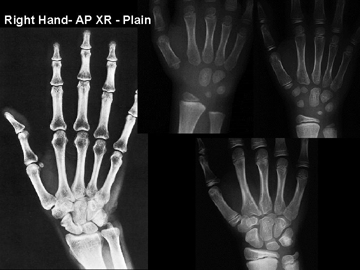 Right Hand- AP XR - Plain 