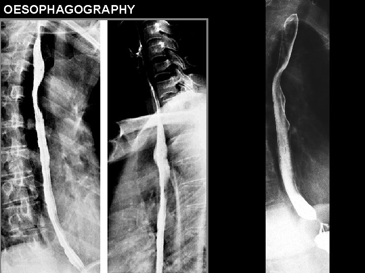 OESOPHAGOGRAPHY 