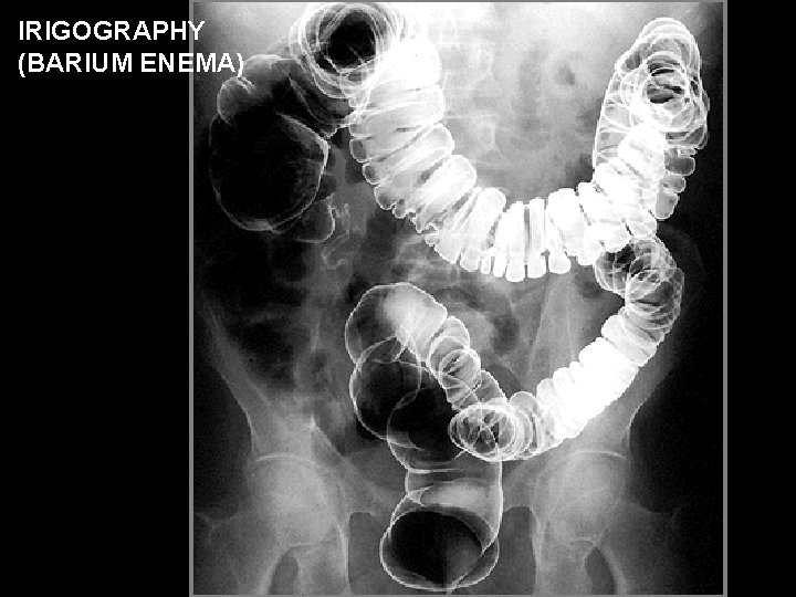 IRIGOGRAPHY (BARIUM ENEMA) 