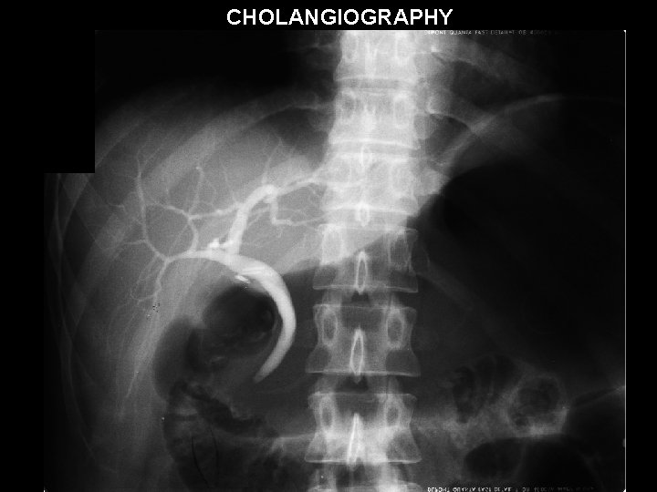 CHOLANGIOGRAPHY 