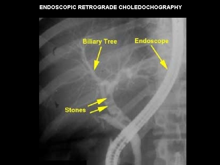 ENDOSCOPIC RETROGRADE CHOLEDOCHOGRAPHY 