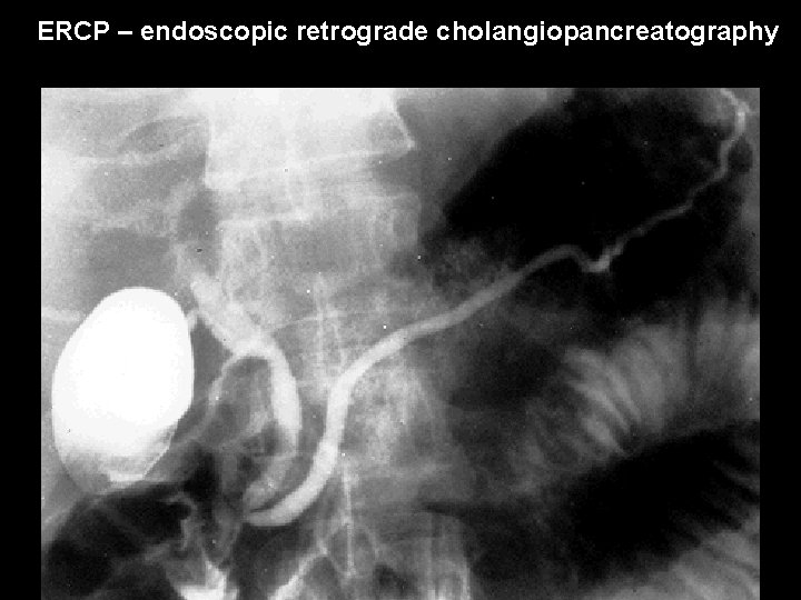 ERCP – endoscopic retrograde cholangiopancreatography 