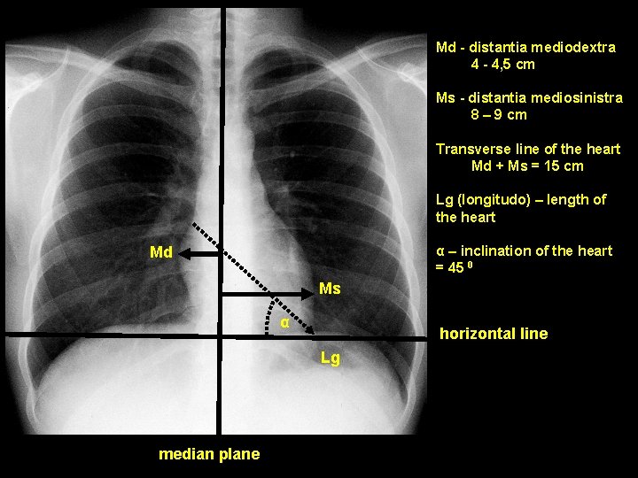 Md - distantia mediodextra 4 - 4, 5 cm Ms - distantia mediosinistra 8