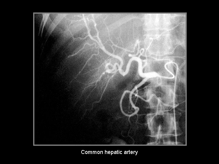 Common hepatic artery 