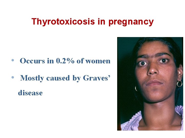 Thyrotoxicosis in pregnancy • Occurs in 0. 2% of women • Mostly caused by