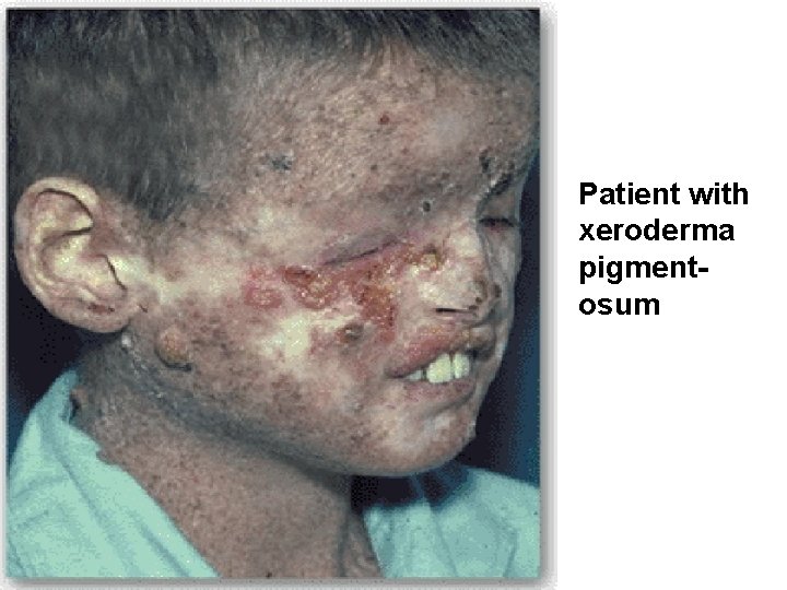 Patient with xeroderma pigmentosum 