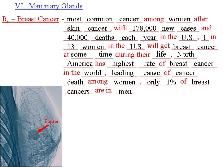 VI. Mammary Glands Rx – Breast Cancer -_____ most ____ common _______ cancer among