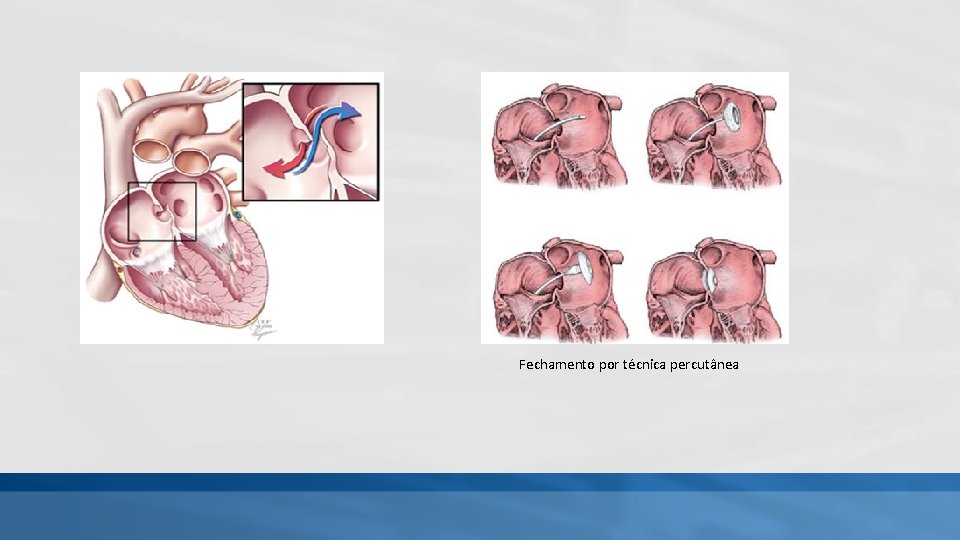 Fechamento por técnica percutânea Fechamento por técnica percutânea
