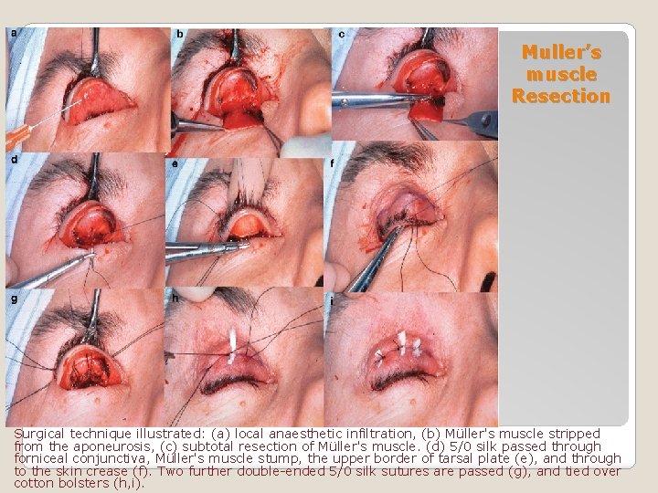 Muller’s muscle Resection Surgical technique illustrated: (a) local anaesthetic infiltration, (b) Müller's muscle stripped