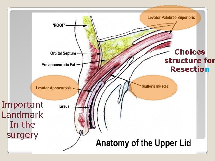 Choices structure for Resection Important Landmark In the surgery 