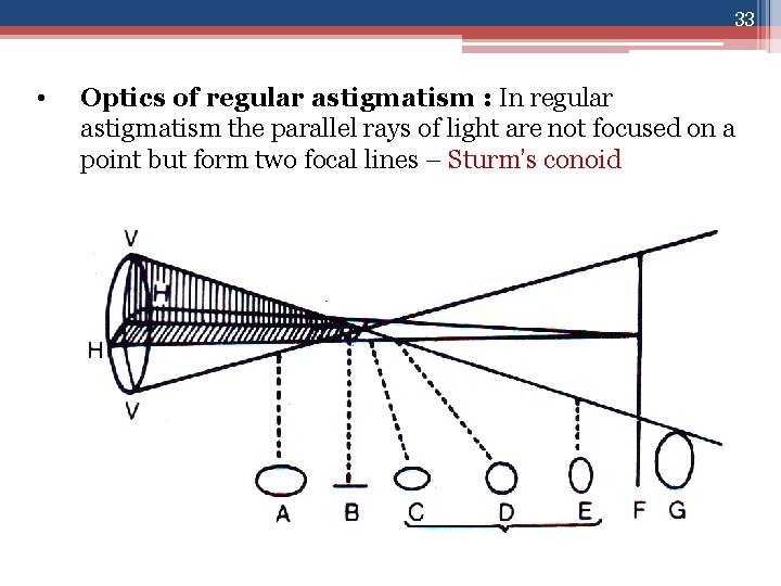 33 • Optics of regular astigmatism : In regular astigmatism the parallel rays of