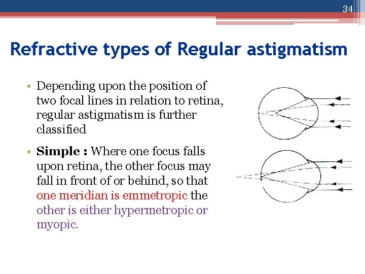34 Refractive types of Regular astigmatism • Depending upon the position of two focal