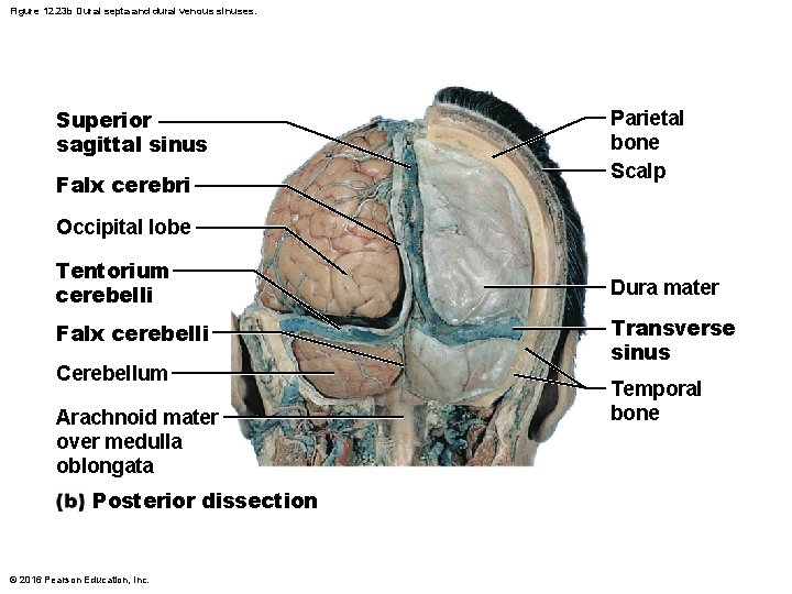 Figure 12. 23 b Dural septa and dural venous sinuses. Superior sagittal sinus Falx Figure 12. 23 b Dural septa and dural venous sinuses. Superior sagittal sinus Falx