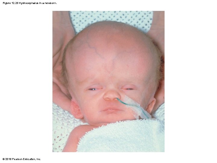 Figure 12. 25 Hydrocephalus in a newborn. © 2016 Pearson Education, Inc. Figure 12. 25 Hydrocephalus in a newborn. © 2016 Pearson Education, Inc.