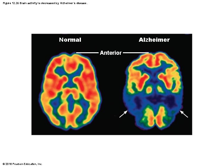 Figure 12. 26 Brain activity is decreased by Alzheimer’s disease. Normal Alzheimer Anterior © Figure 12. 26 Brain activity is decreased by Alzheimer’s disease. Normal Alzheimer Anterior ©