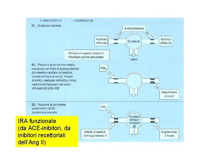 IRA funzionale (da ACE-inibitori, da inibitori recettoriali dell’Ang II) IRA funzionale (da ACE-inibitori, da inibitori recettoriali dell’Ang II)