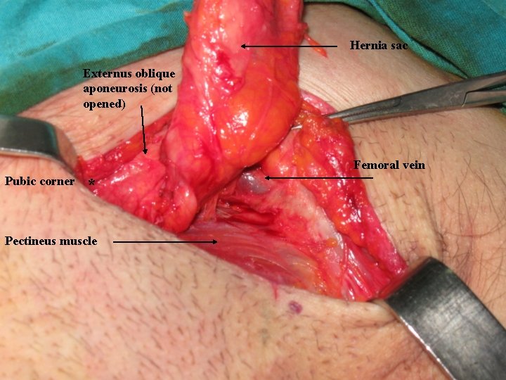Hernia sac Externus oblique aponeurosis (not opened) Femoral vein Pubic corner * Pectineus muscle Hernia sac Externus oblique aponeurosis (not opened) Femoral vein Pubic corner * Pectineus muscle